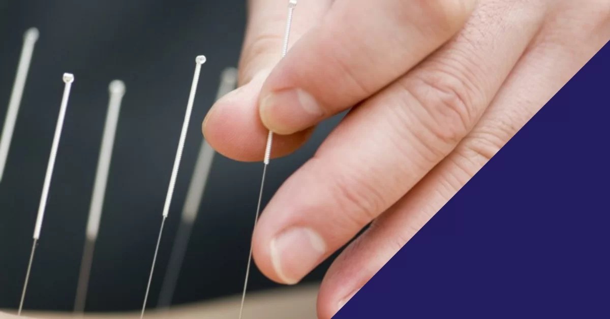 Your Dry Needling Questions Answered! Aspire Physiotherapy