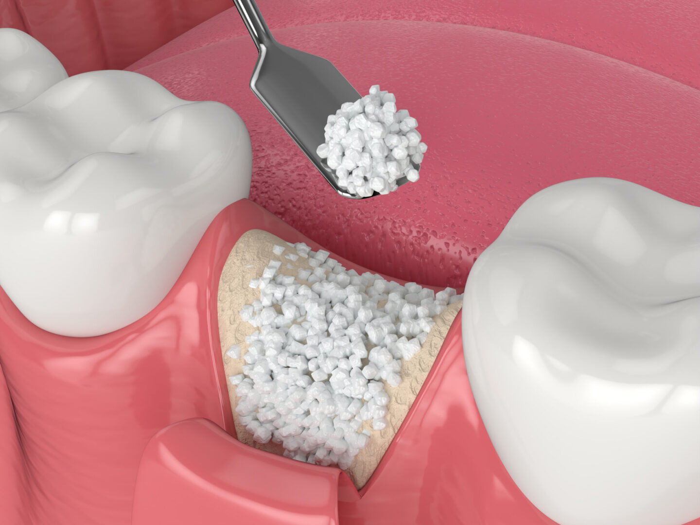 Bone Grafting in Salt Lake City, UT Aspire Surgical