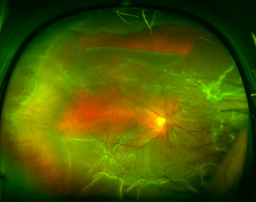 » RETINAL DETACHMENT