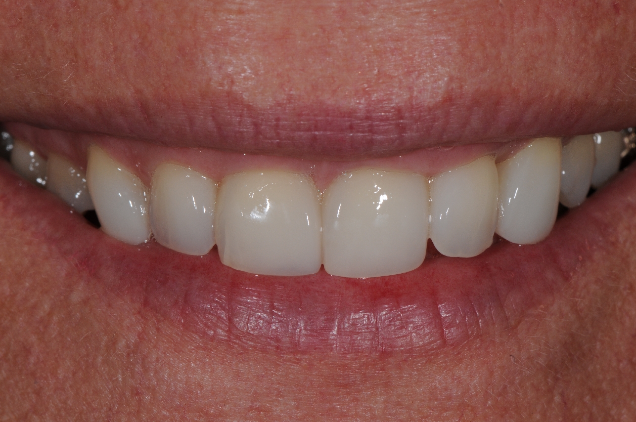 Services Smile Rejuvenation Brisbane Prosthodontics