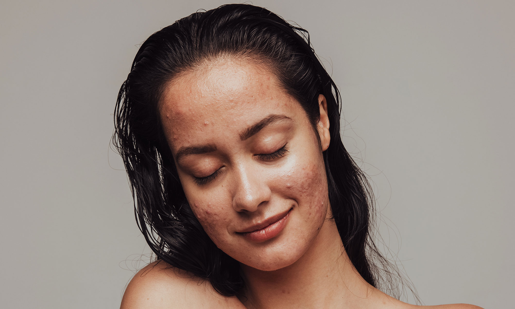 How to Treat Forehead Acne (and Prevent It From Coming Back) Software