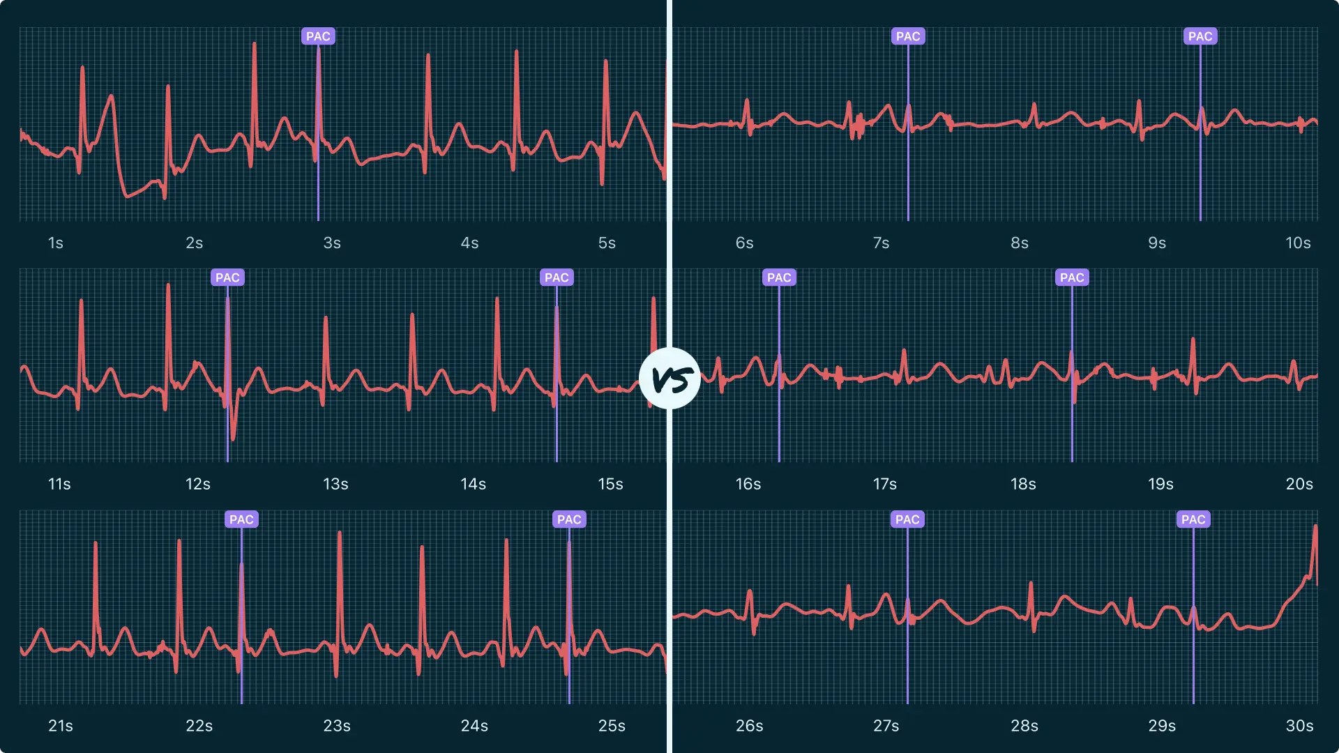 Premature Atrial Contraction (Multiple) Vs. Atrial Trigeminy on Your