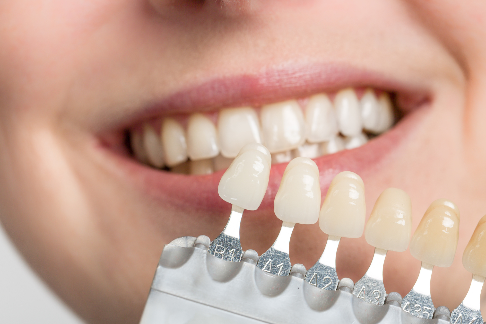 How Long Do Veneers Last? Veneer Lifespan, Caring For Veneers, And More