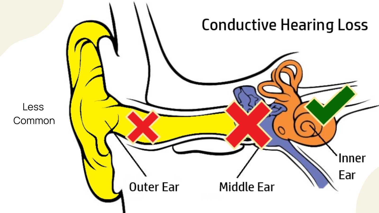 Most Common Types of Hearing Loss Sensorineural, Conductive and Mixed