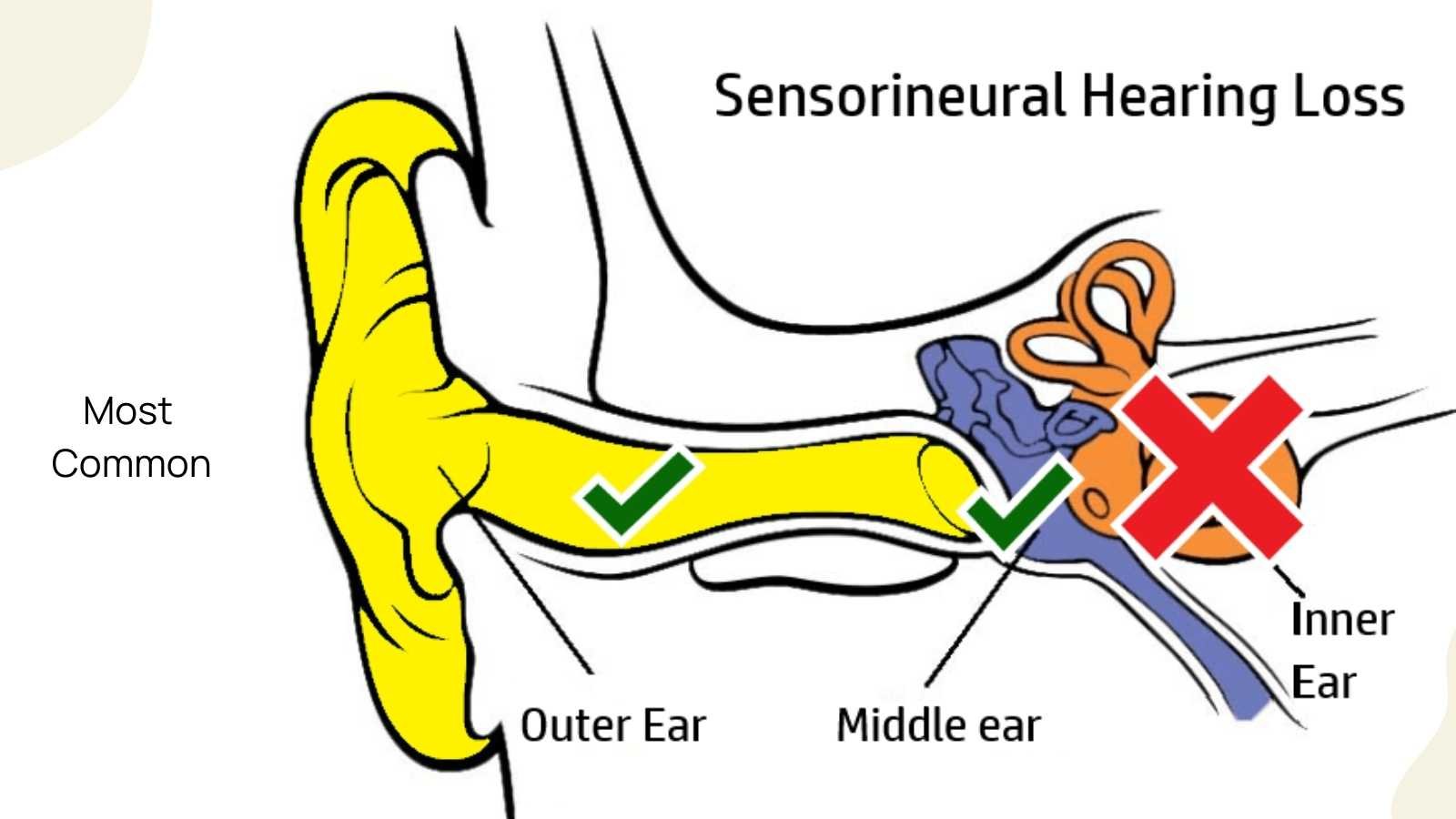 Most Common Types of Hearing Loss Sensorineural, Conductive and Mixed