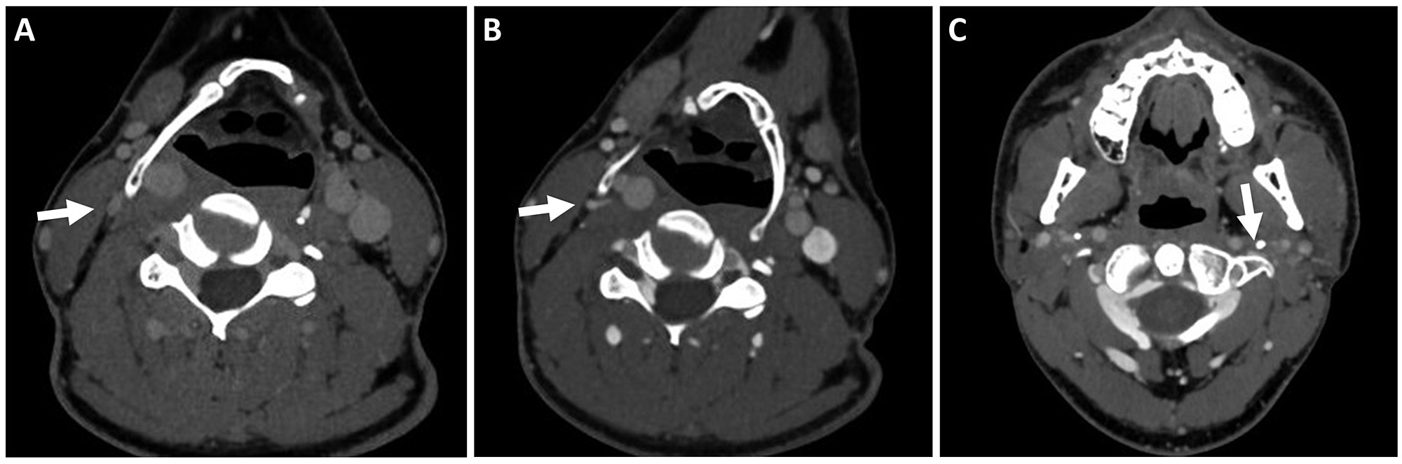 Cureus Dynamic Internal Jugular Vein Compression by Hypertrophic Hyoid Bone Management and