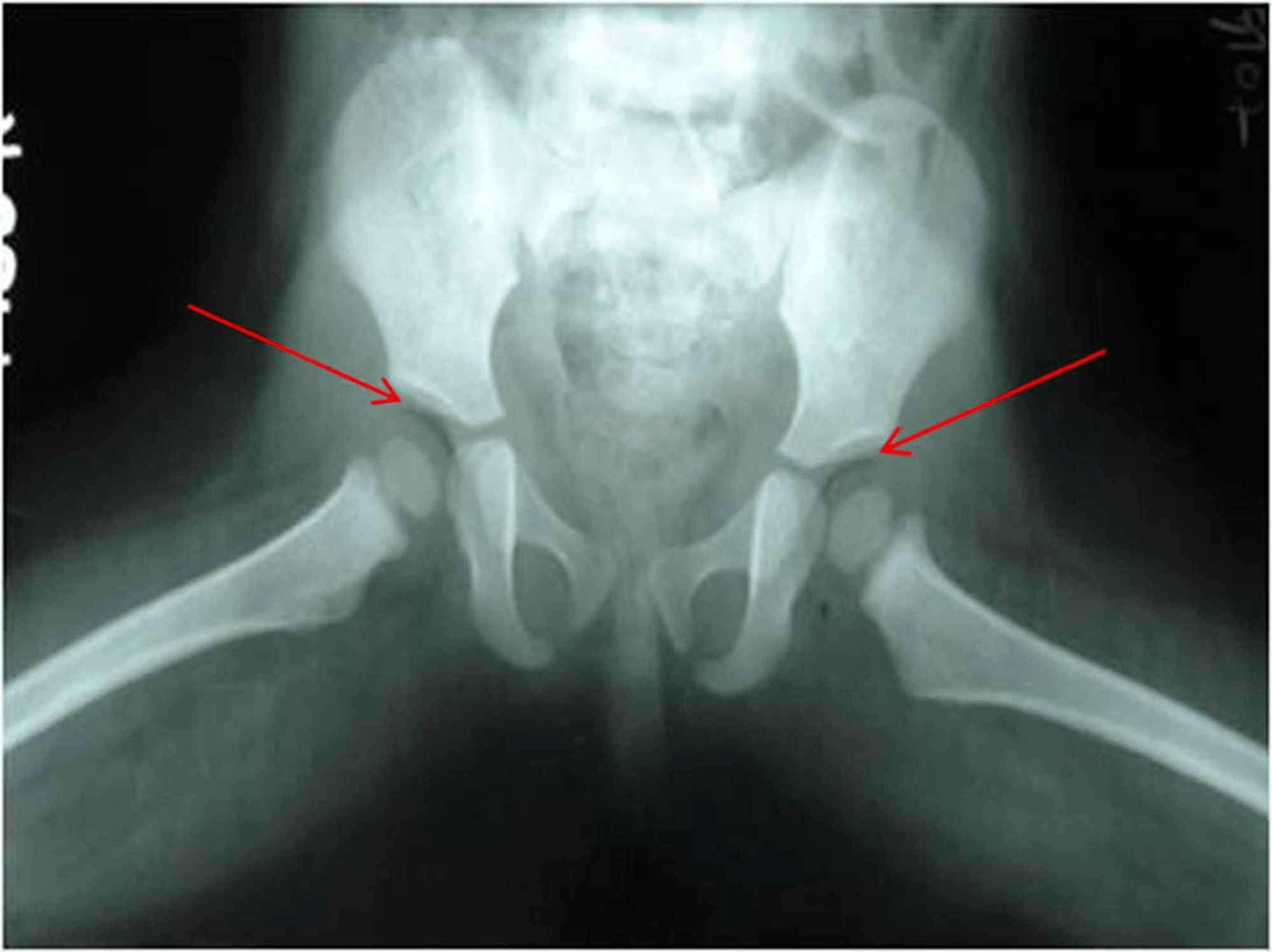 Cureus The Air Inside Joint A Sign of Disease Pathology or a Benign