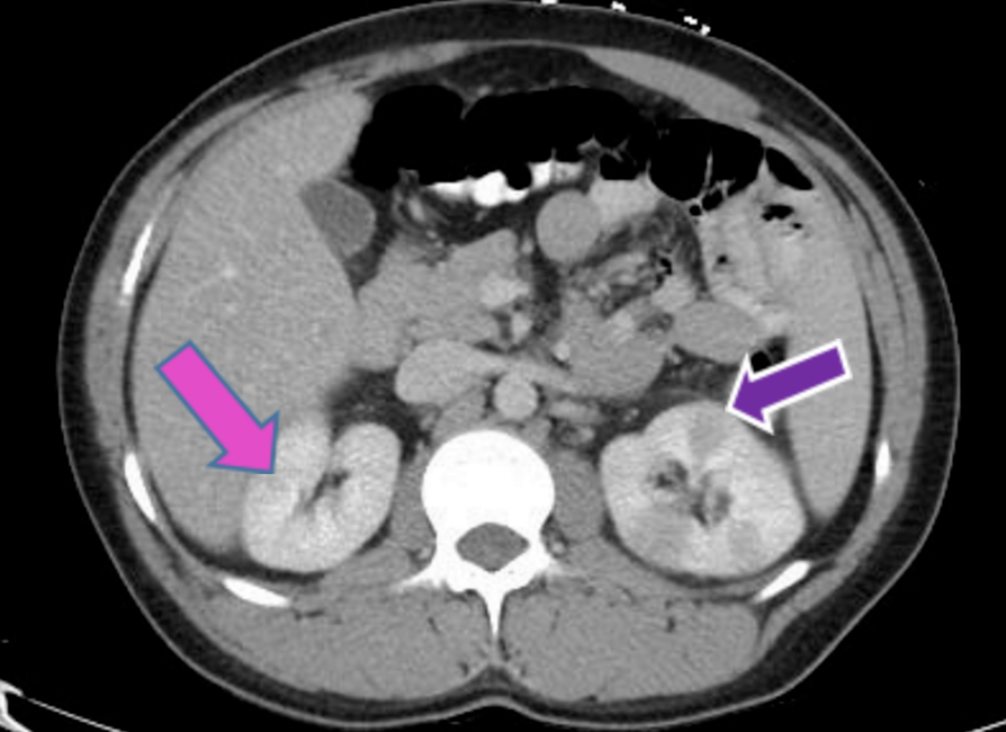 Cureus Recurrent Urinary Tract Infection in a Patient With