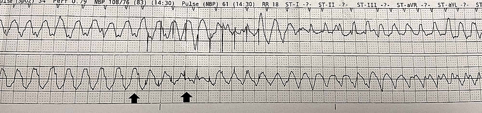 Cureus A Challenging Case of Electrical Storm in an Implantable Cardioverter Defibrillator Patient