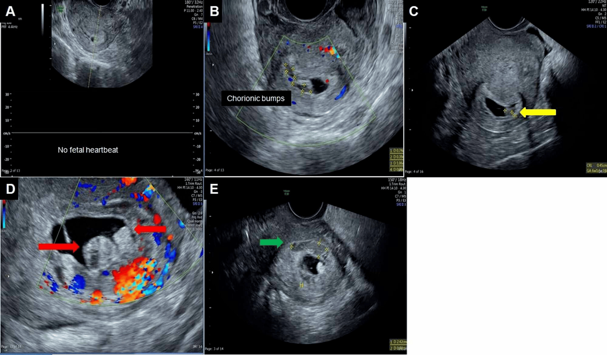 Cureus Chorionic Bump Radiologic Features and Pregnancy