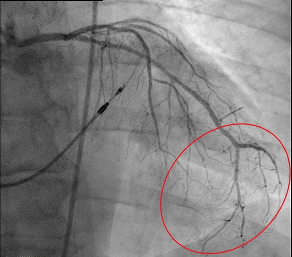 Cureus A Unique Case of Acute Coronary Syndrome in a Patient With