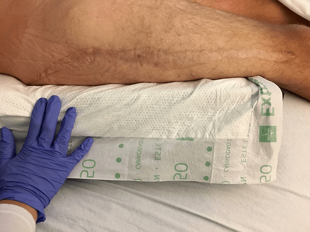 Gluteal Compartment Syndrome