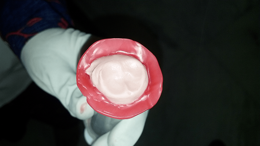 Cureus A Multidisciplinary Approach for Rehabilitation of Enucleated