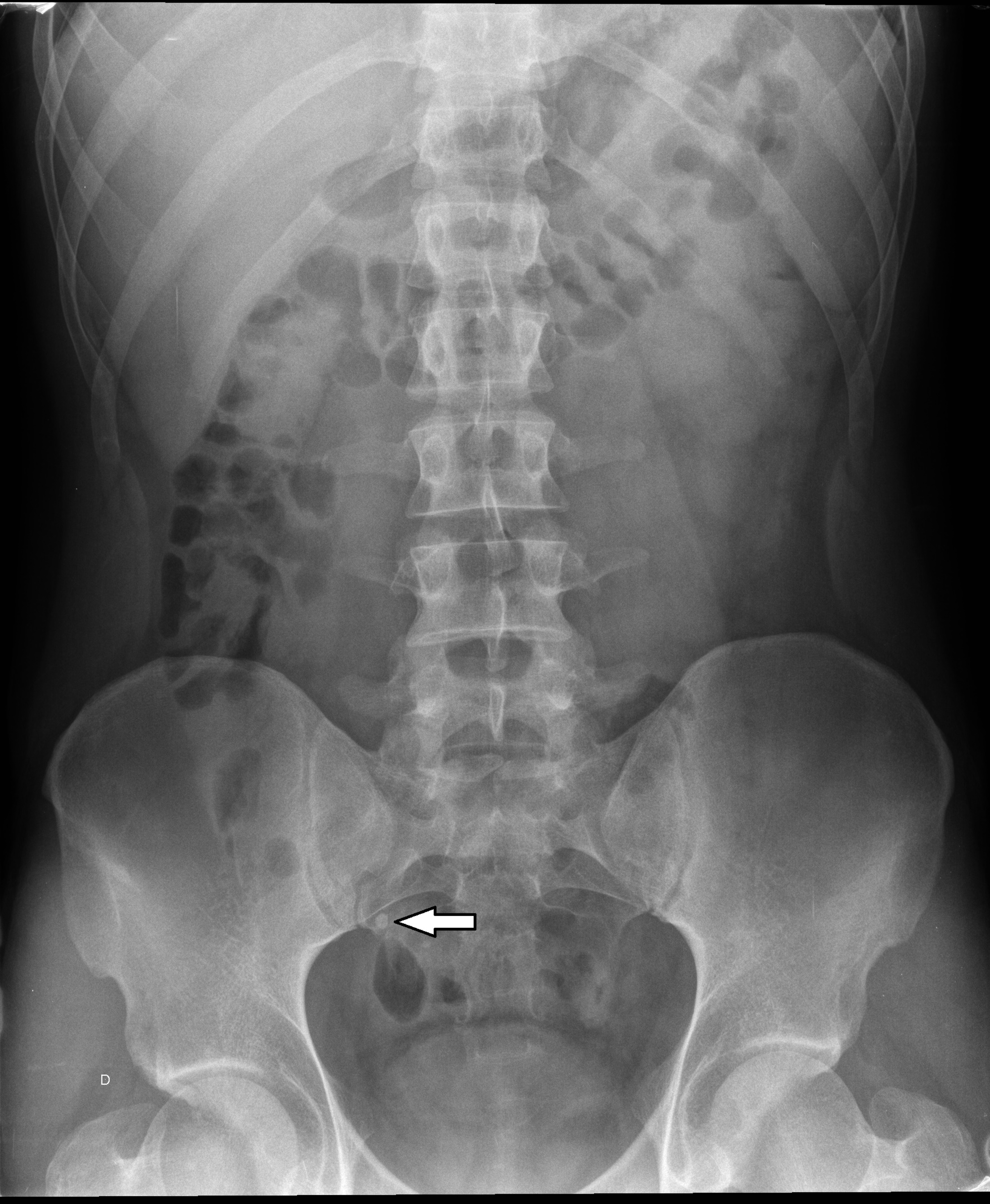 Abdominal X Ray 233
