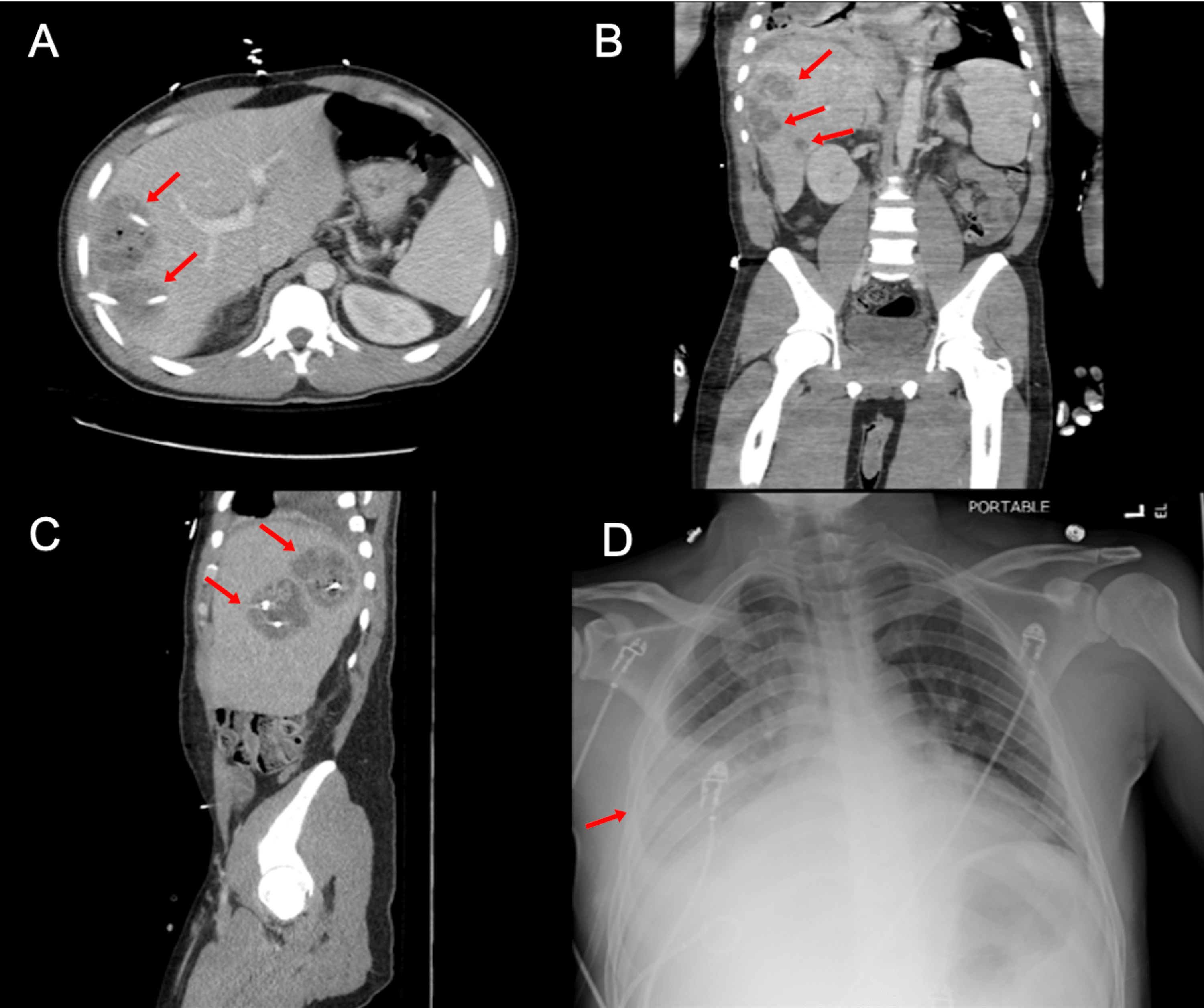 Cureus Amebic Liver Abscess Complicated With a Pleural Effusion A