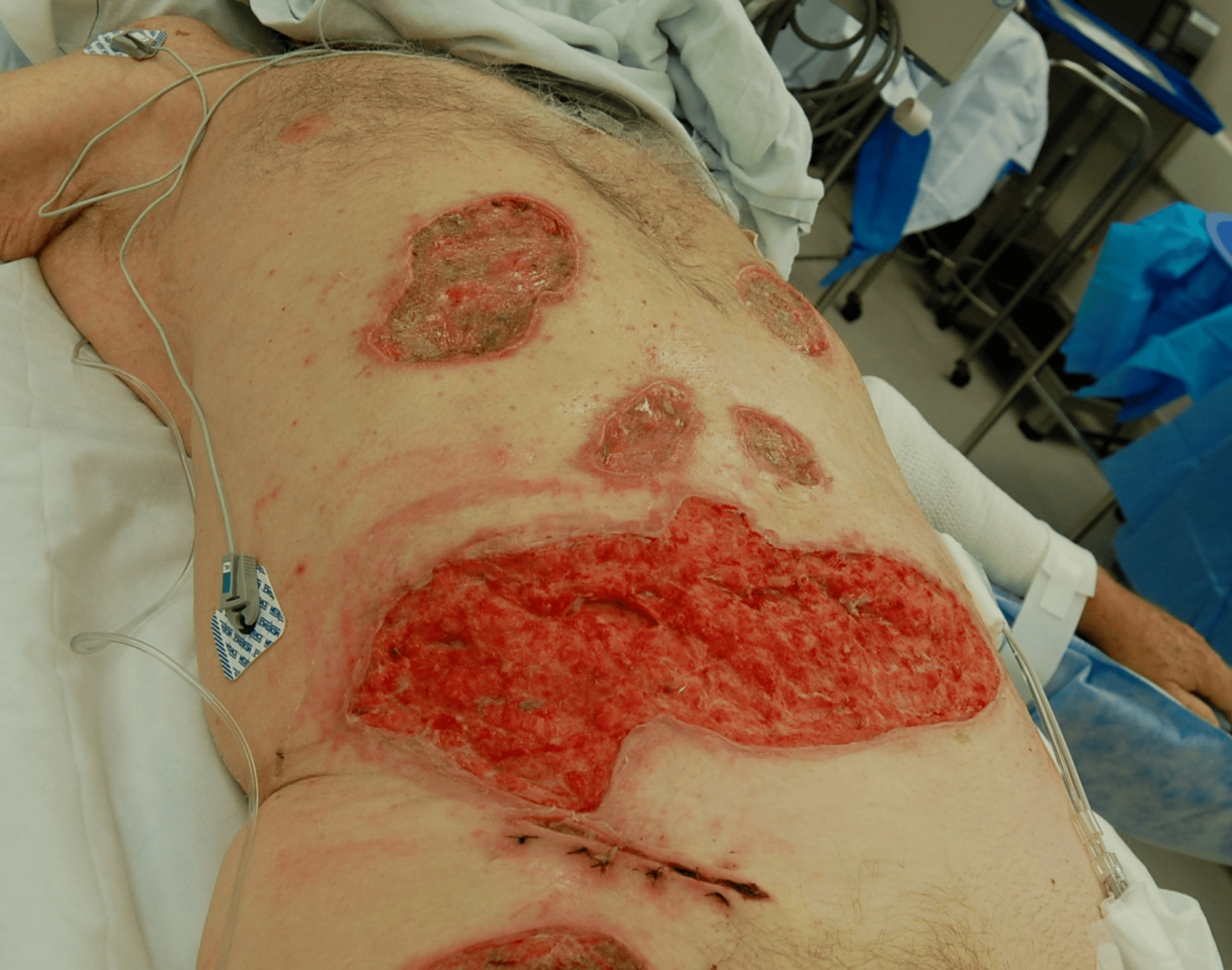 Cureus The Use of V.A.C. VERAFLO CLEANSE CHOICE in the Burn Population