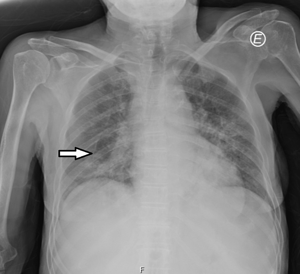 Luxatio Erecta A Case Report and Literature Review TrendRadars