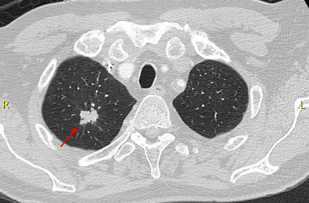 Cureus Abscopal Resolution of a Hepatic Metastasis in a Patient with