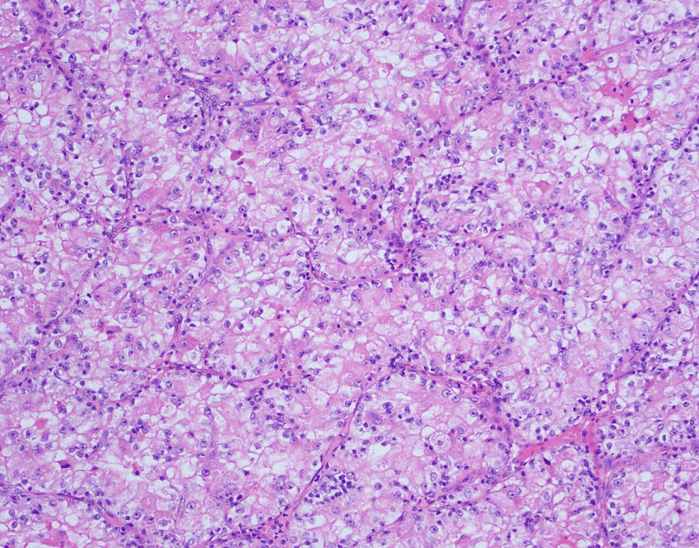 Cureus A Pedunculated Skin Lesion in a Case of Clear Cell Renal Carcinoma