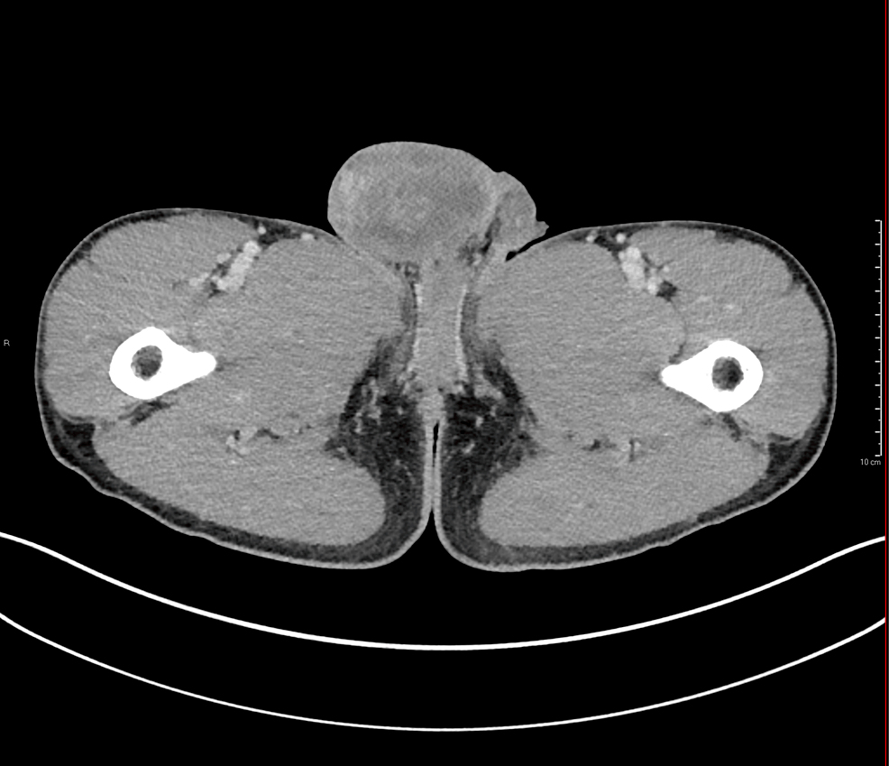 Cureus A Rare Case of Postorchidectomy Arterial Injury With Rapidly
