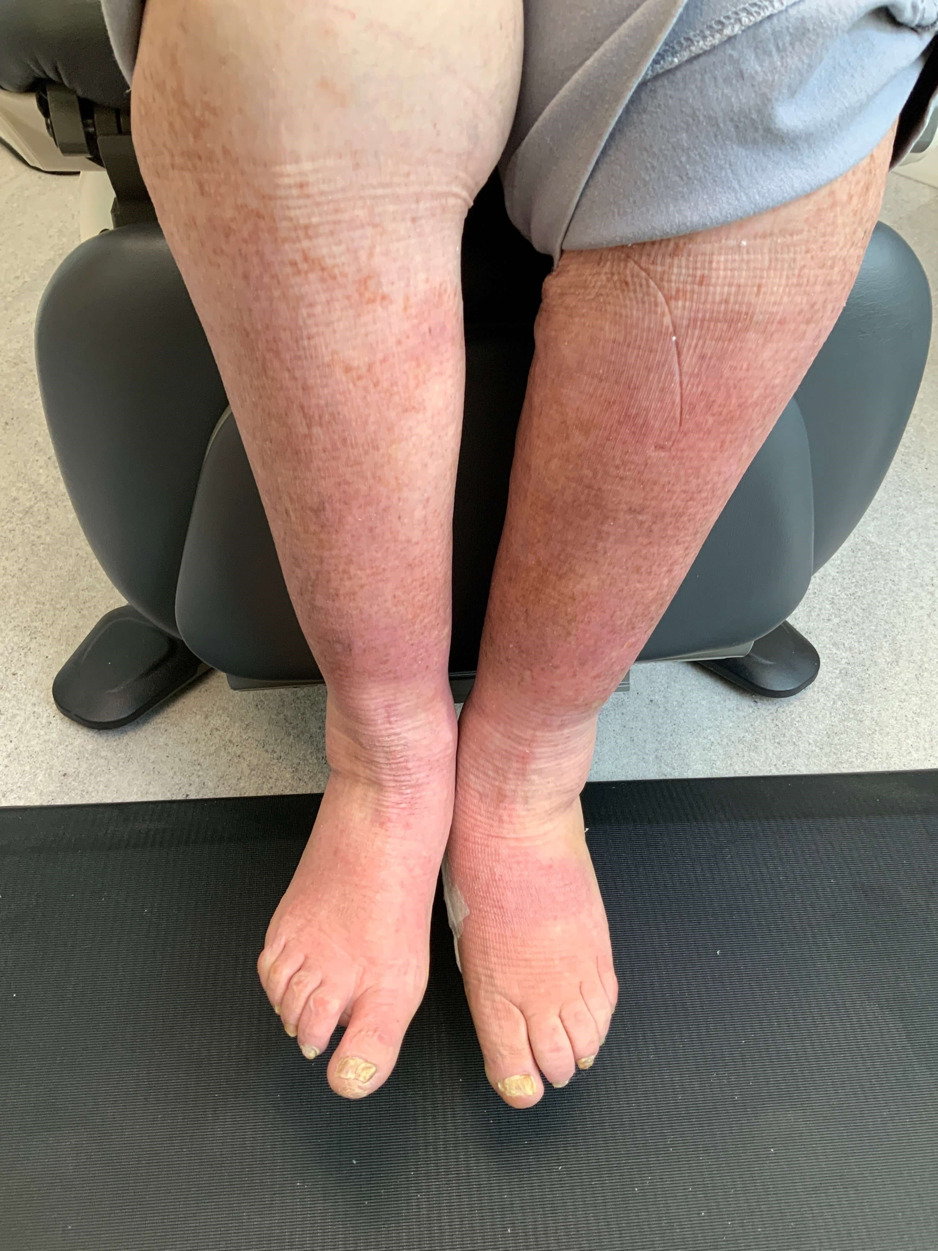 Before and After Eczema & Rashes Photos