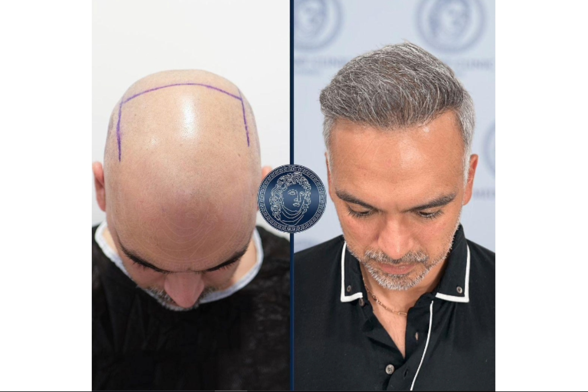 What To Expect From Hair Transplant In Turkey Entrepreneur