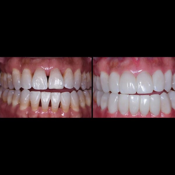 How Bioclear Empowers Dentists To Treat Black Triangles