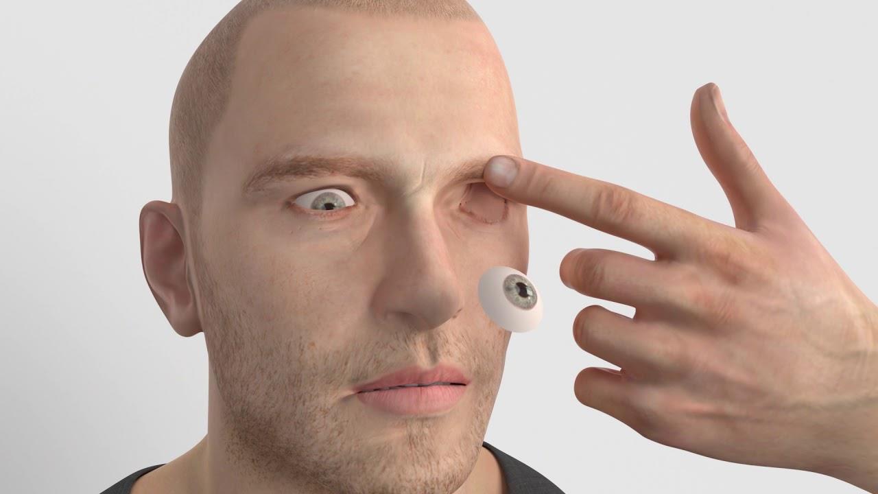 The Lesser Known Facts About Artificial Eyes by prostheticeyecenter Issuu