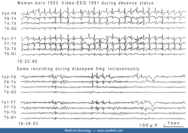 Absence status epilepticus (ASE) MedLink Neurology