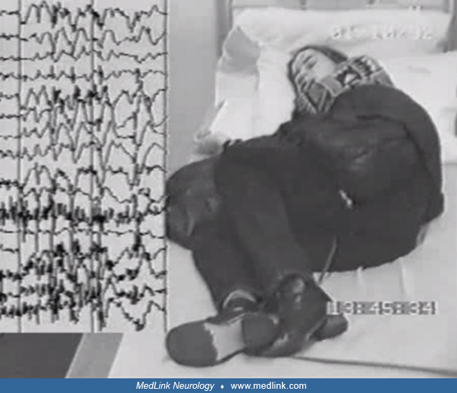 Focal onset generalized absence seizures MedLink Neurology