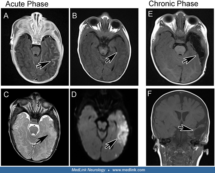 Neonatal herpes encephalitis MedLink Neurology