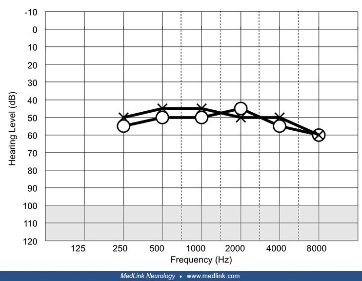 Meniere syndrome MedLink Neurology