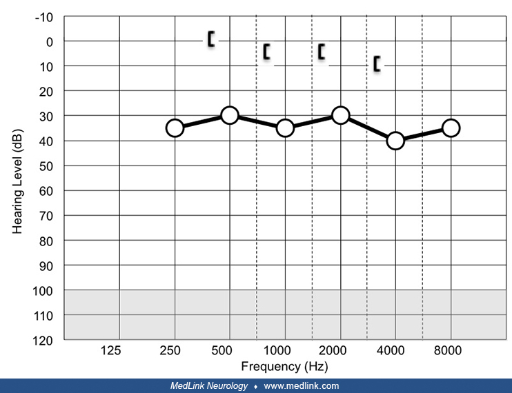 Subjective tinnitus MedLink Neurology