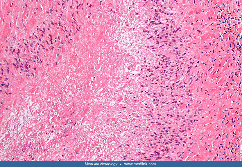 Sydenham chorea MedLink Neurology