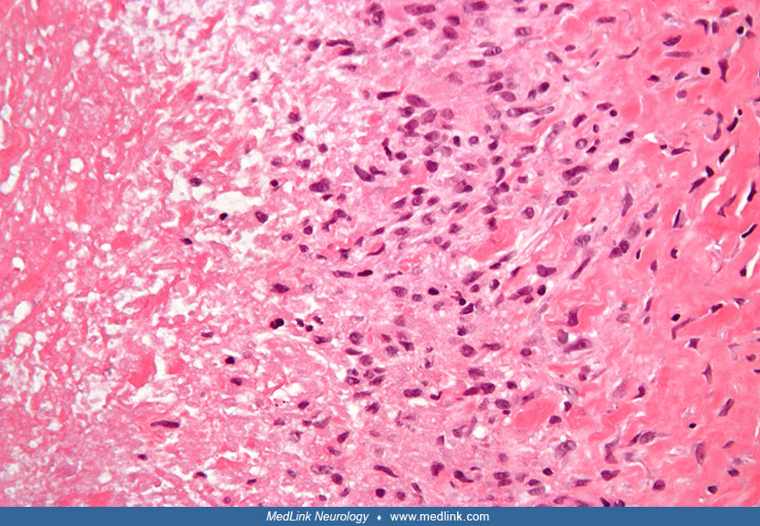 Sydenham chorea MedLink Neurology