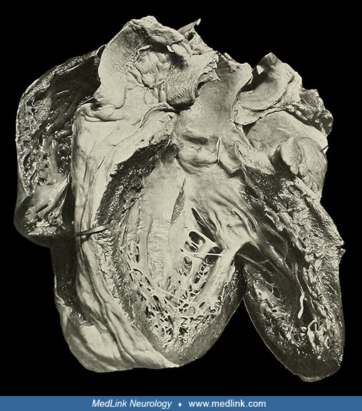 Sydenham chorea MedLink Neurology