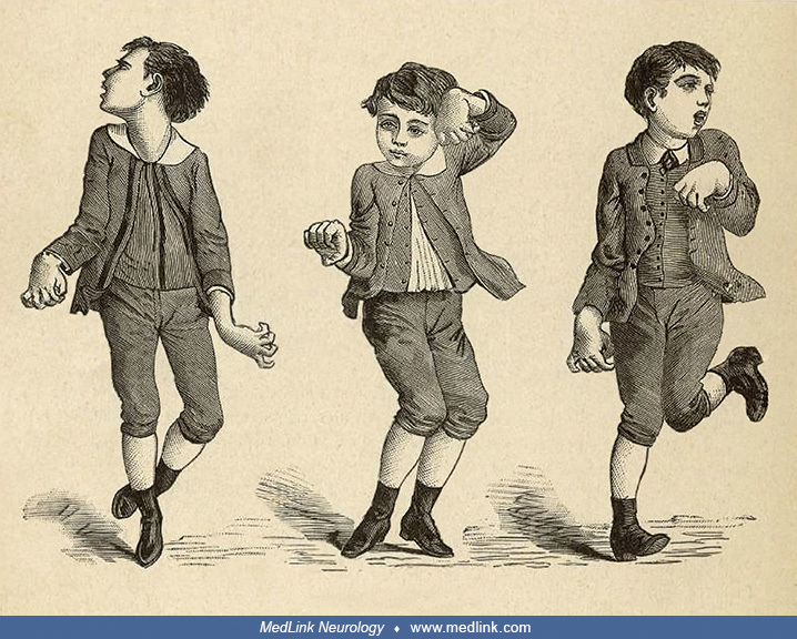 Sydenham chorea MedLink Neurology