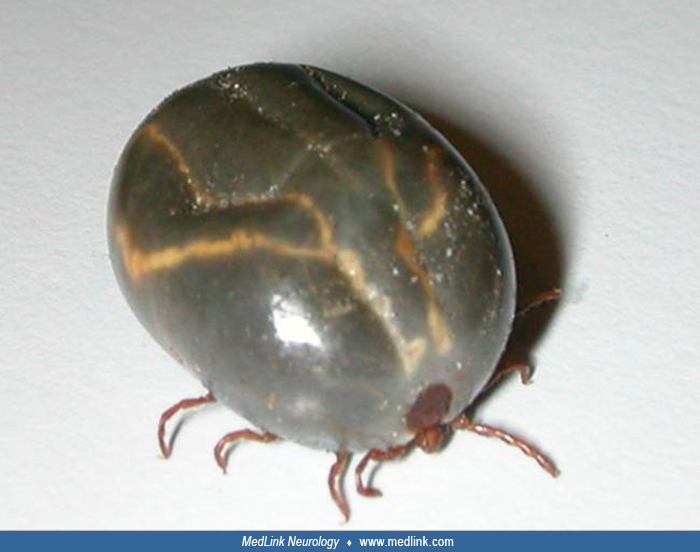 Tick paralysis MedLink Neurology