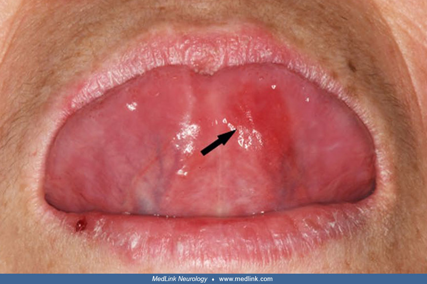 Vitamin B12 Deficiency Tongue