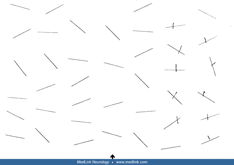 Neglect MedLink Neurology