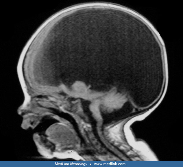 WalkerWarburg syndrome (WWS) MedLink Neurology