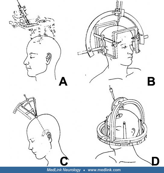 Stereotactic neurosurgery MedLink Neurology