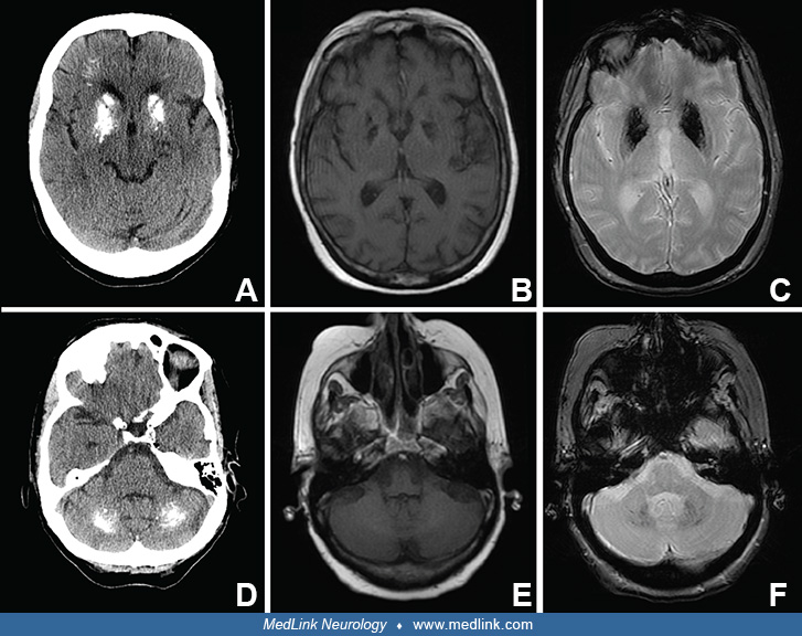 Idiopathic basal ganglia calcification (IBGC) MedLink Neurology