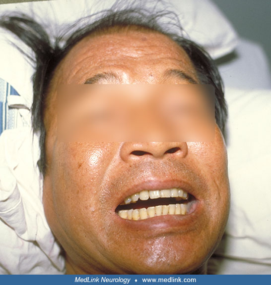 Tetanus MedLink Neurology