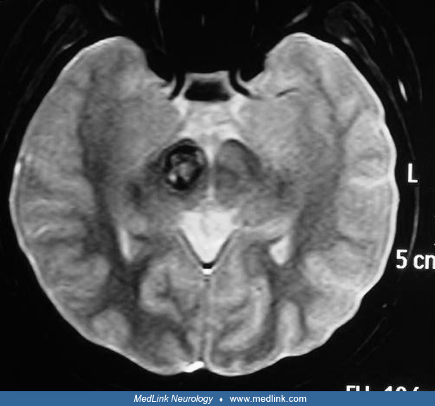 Thalamic hemorrhage MedLink Neurology