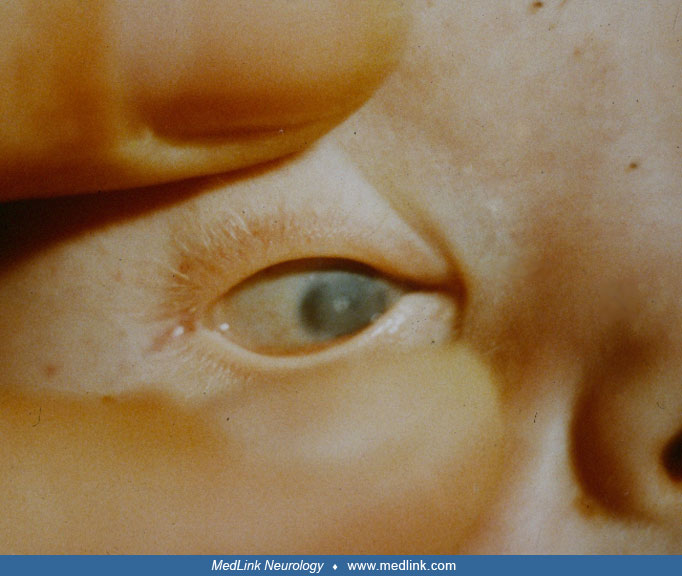 WalkerWarburg syndrome (WWS) MedLink Neurology