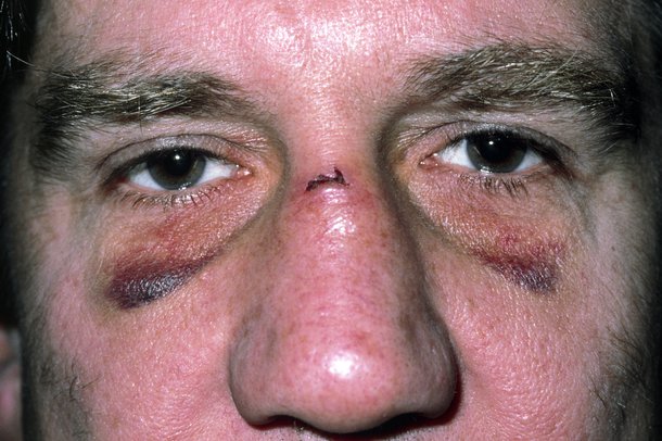 Broken nose NHS.UK