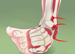 Wat Te Doen Bij Een Verzwikte Enkel | Fit4All Fysiotherapie & Sport | Fit4All Fysiotherapie & Sport