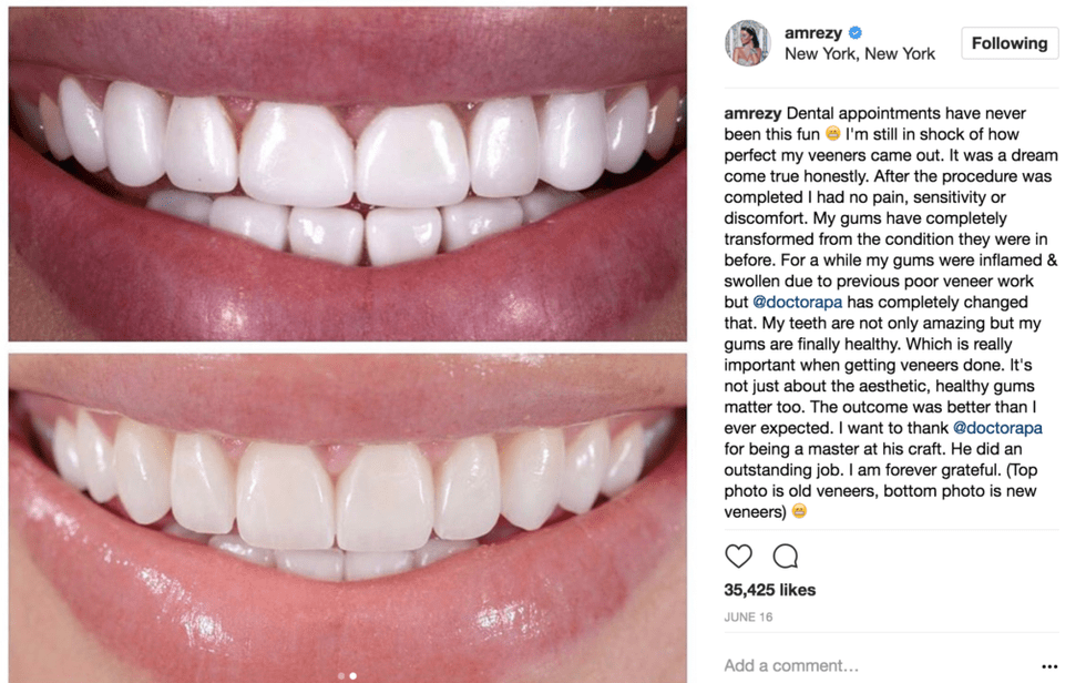 The Perfect Smile 4 Influencers Give The 411 On Having Veneers xoNecole