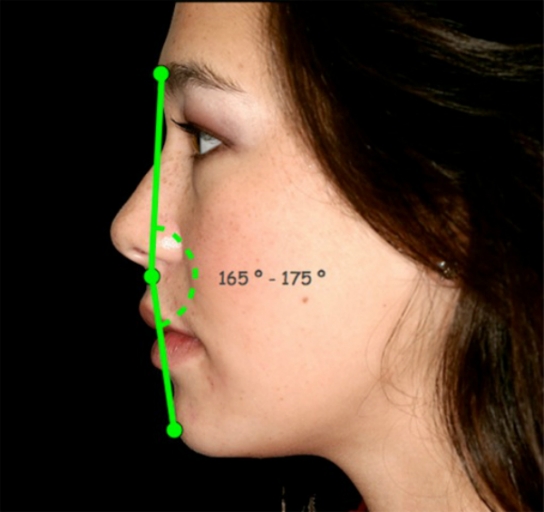 Evaluating Facial Esthetics Facial profile Spear Education